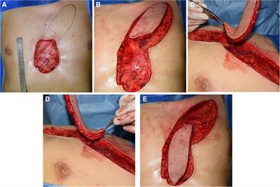 Impact of internal mammary artery perforator propeller flaps combined with radiotherapy in the treatment of large chest keloids: Our experience